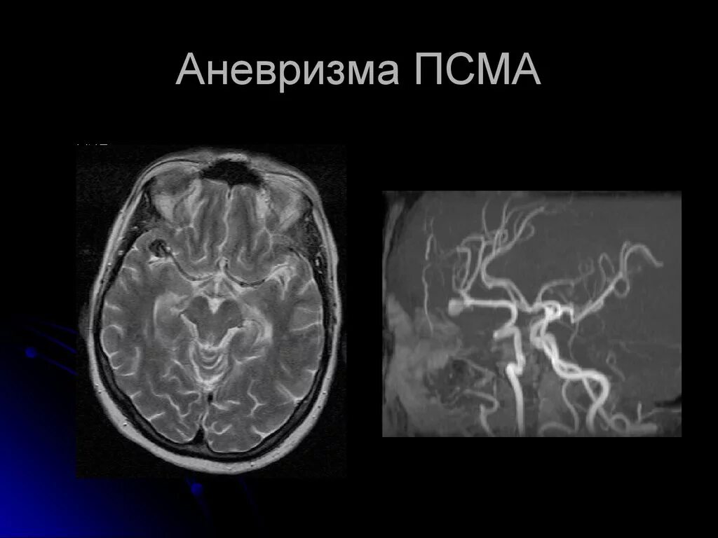 Аневризма сосудов головного мозга. Аневризма головного мозга классификация. Аневризмы сосудов головного мозга классификация. Аневризма мозга простыми словами