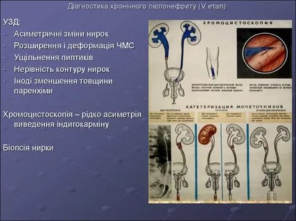 Деформация почек