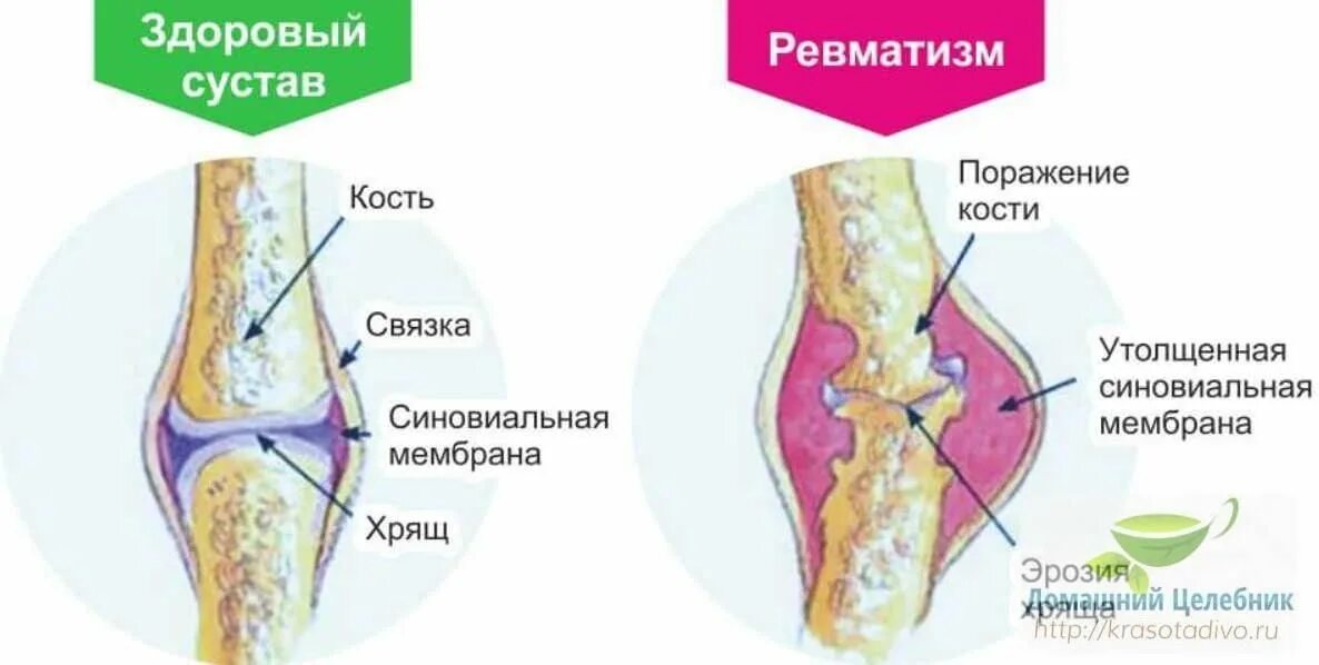 Как лечить ревматизм суставов. Ревматизм поражение суставов. ревматизм поражение сутав.