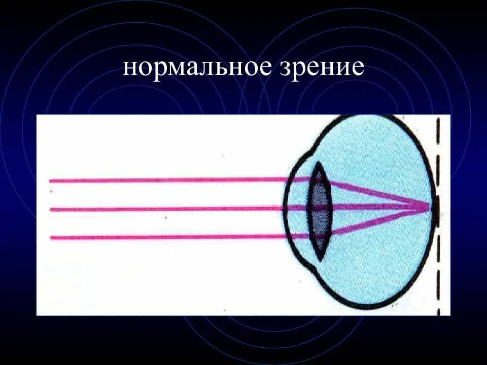 1 это нормальное зрение. Нормальное зрение. Нормальное зрение рисунок. Нормальное зрение у человека. Схема нормального зрения человека.