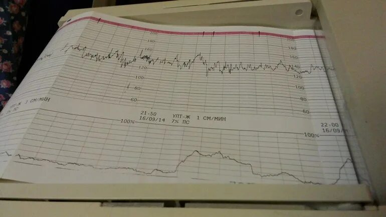 Схватки на КТГ. Родовые схватки на КТГ. Схватка на КТГ. Сокращение матки на КТГ. Тонус 34 неделя