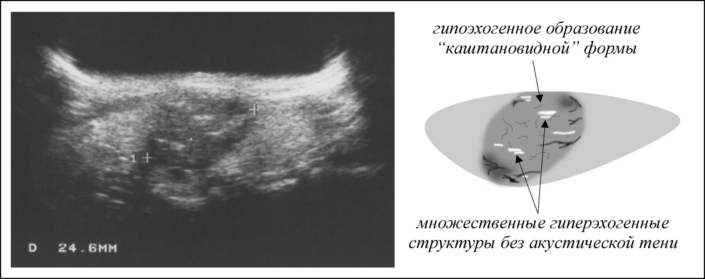 Образование без акустической тени. Гиперэхогенные образования молочных желез УЗИ. УЗИ щитовидной железы гипоэхогенное образование. УЗИ гетерогенная структура молочных желез.
