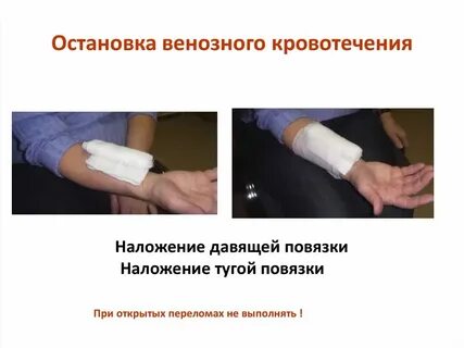 Наложение повязки при кровотечении алгоритм