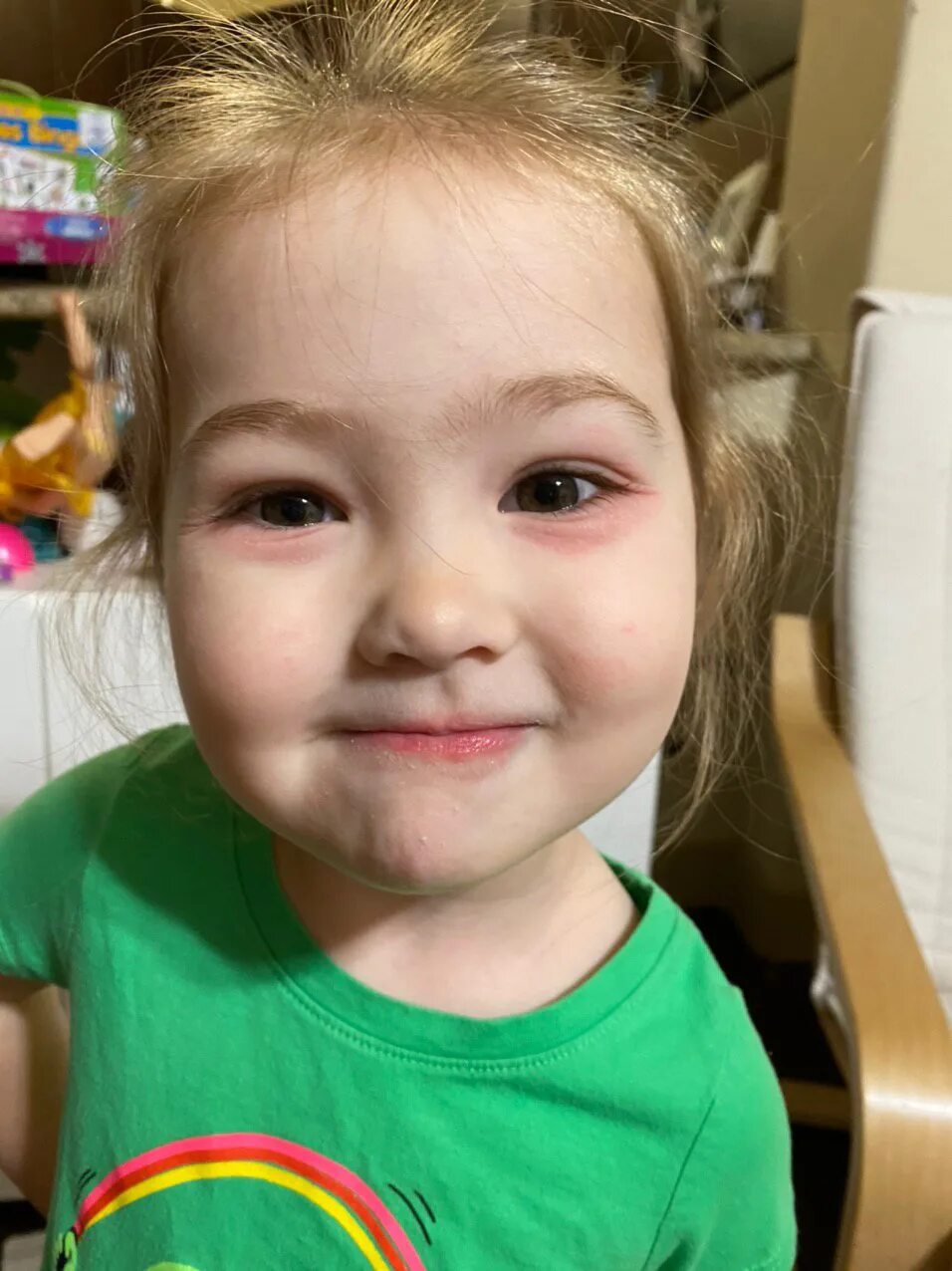 Гонобленорейный конъюнктивит. Тёмные круги под глазами у ребёнка. Аллергические круги под глазами у детей. Поллинозный конъюнктивит. Аденовирусный конъюнктиви.