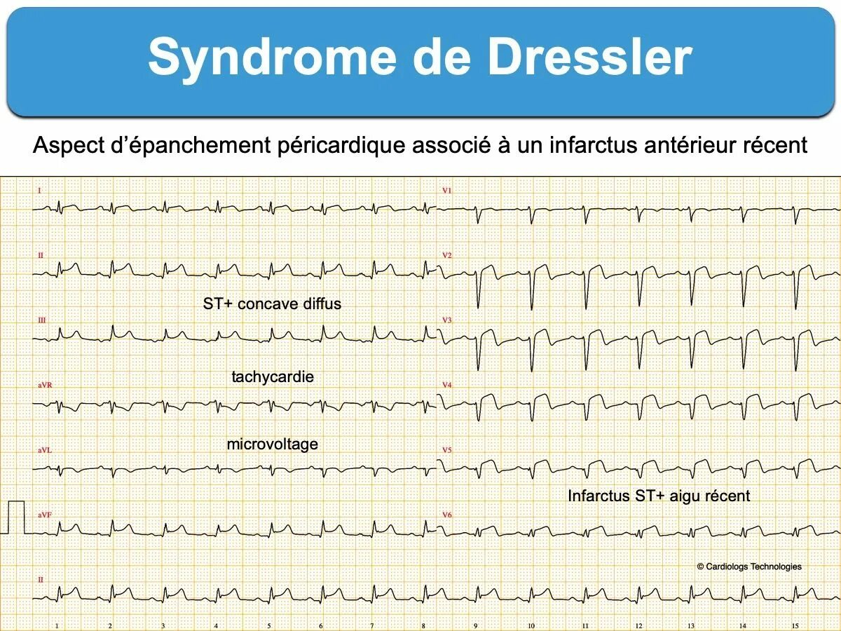 Синдром дресслера это. Постинфарктный синдром Дресслера. Синдром Дресслера диагностика. Синдром Дресслера патогенез. Синдром Дресслера в кардиологии.