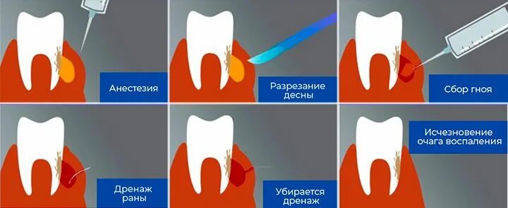 Обезболивающее после удаления