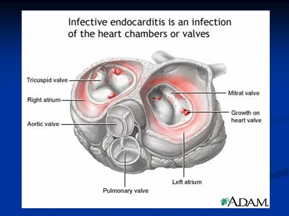 Инфекционный эндокардит трехстворчатого клапана. Инфекционный эндокардит митрального клапана. Эндокардит трикуспидального клапана. Вегетации на митральном клапане. Вегетация сердца
