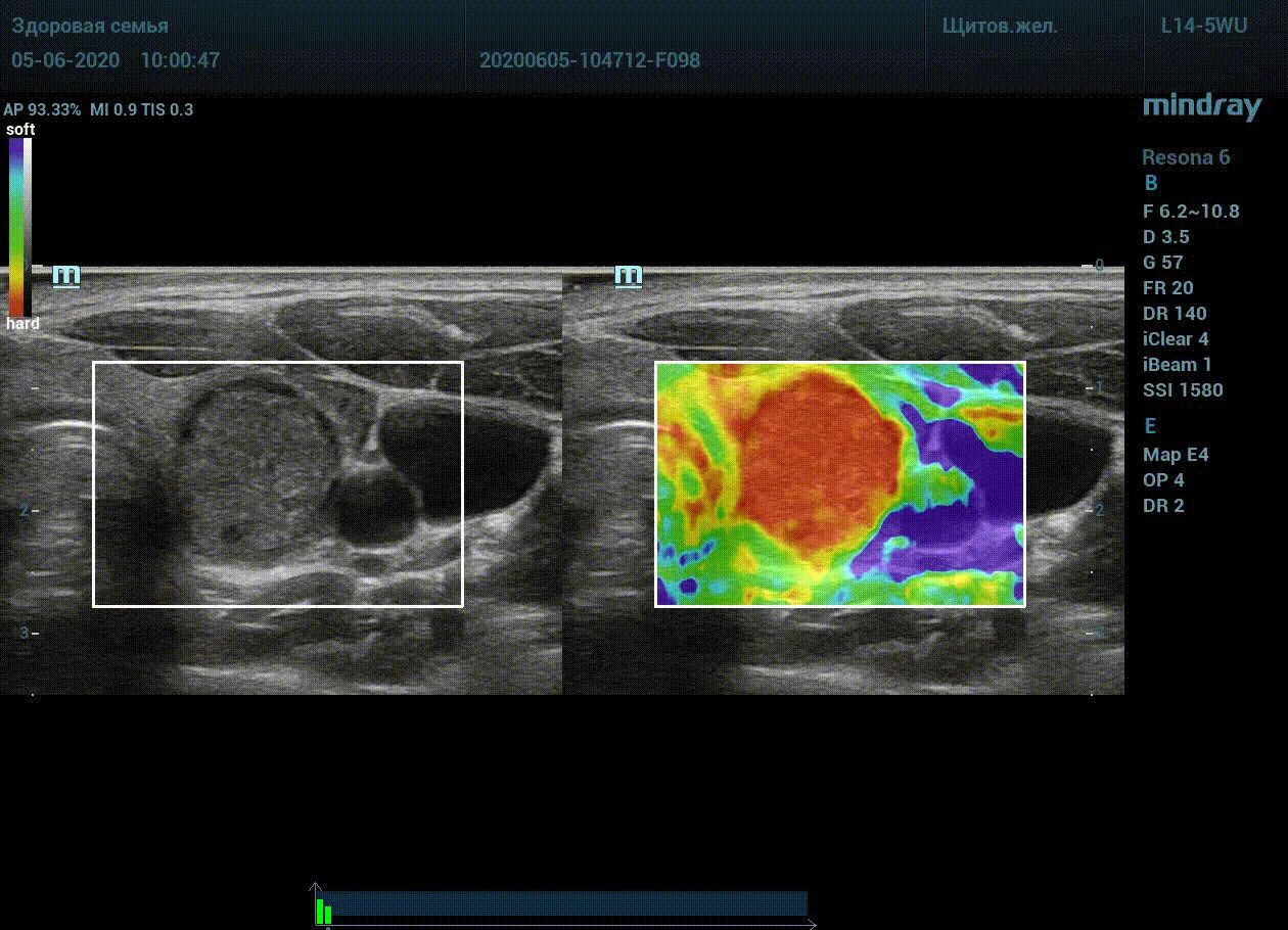 Эластография щитовидной железы что это. Эластография сдвиговой волны печени. Ультразвуковая эластография молочной железы. Компрессионная эластография щитовидной железы. «Ультразвуковая эластография и эластометрия.