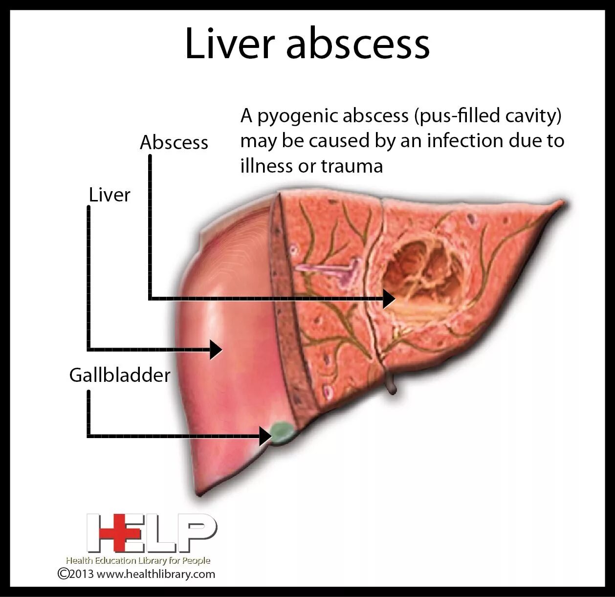 Холангиогенные абсцессы печени. Абсцесс печени на латинском. Отверстие в печени
