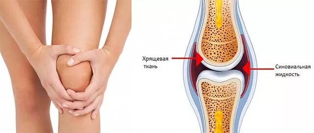 Собирается жидкость в суставах. Синовиальная жидкость в суставах. Синовиальная жидкость в коленном суставе.