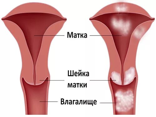 Белое пятно на головке члена - Национальный медицинский форум