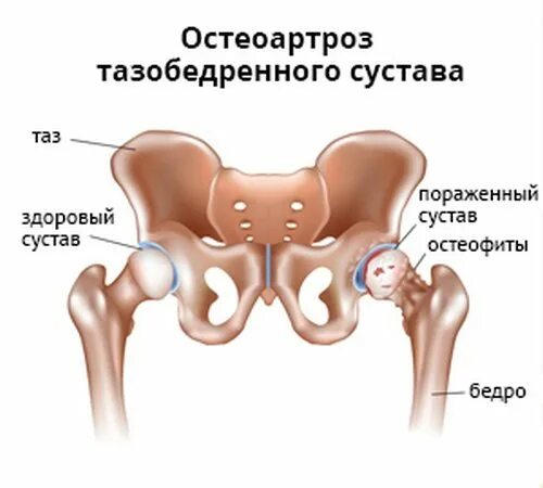деформирующий остеоартроз тазобедренных суставов 2. артрит бедренного сустава симптомы. коксо артроз бедренного сустава симптомы. остеохондроз кости таза. коксартроз тазобедренного сустава.