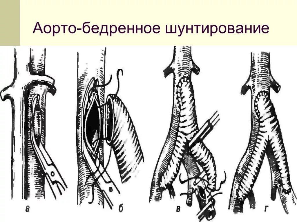 Бедренное шунтирование операция