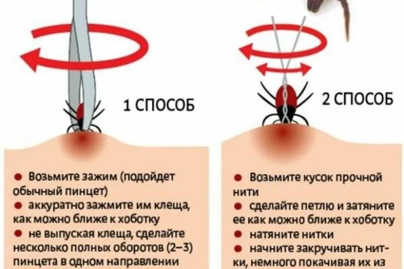 Чем обработать место после клеща. Как убрать клеща с человека ниткой. Как вытащить клеща у человека в домашних условиях правильно. Как удалить клеща у человека ниткой. Удалить клеща ниткой у человека.