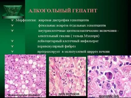 Алкогольная дистрофия печени