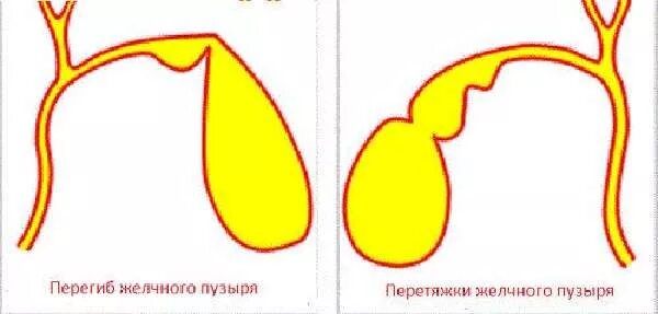 Желчный пузырь форма с перегибом и перетяжкой в шейке. Желчный пузырь неправильной формы с перегибом в области тела. Перегиб нижней трети желчного пузыря. Аномалия желчного пузыря Перегиб. Изгиб шейки желчного