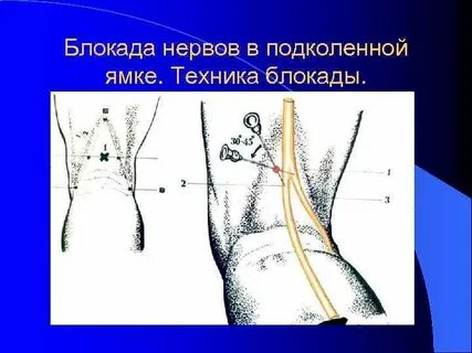 Болит место блокады