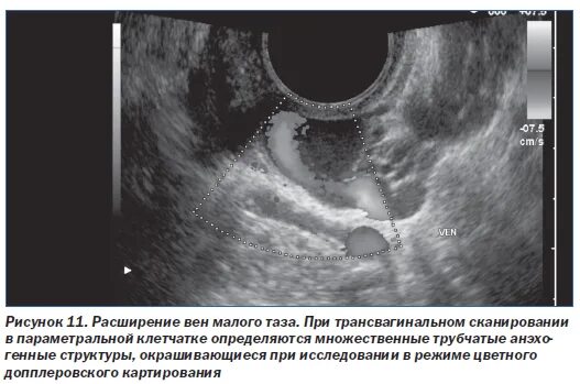 Варикоз малого таза причины. Расширение вен малого таза УЗИ. Варикоз малого таза УЗИ. Варикозное расширение вен малого таза УЗИ. УЗИ малого таза варикозное расширение.