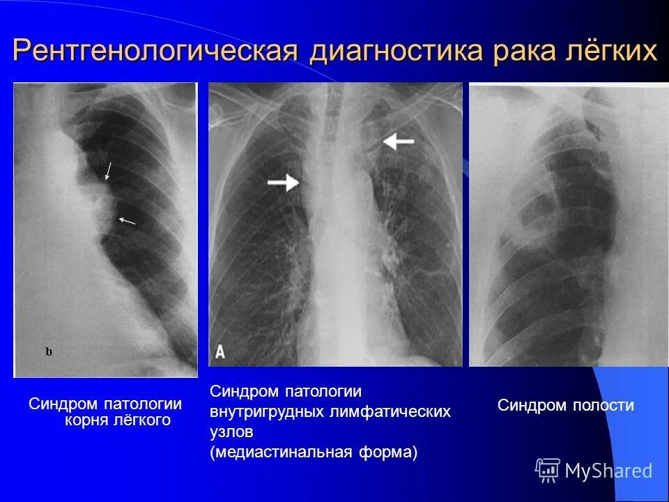 Синдром патологии корня легкого рентген. Синдром патологических изменений корня легкого. Корень легкого на рентгенограмме.