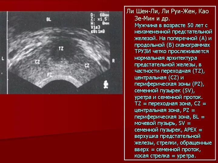 УЗИ предстательной железы трансабдоминально. Трузи предстательной железы норма. Объем предстательной железы на УЗИ.