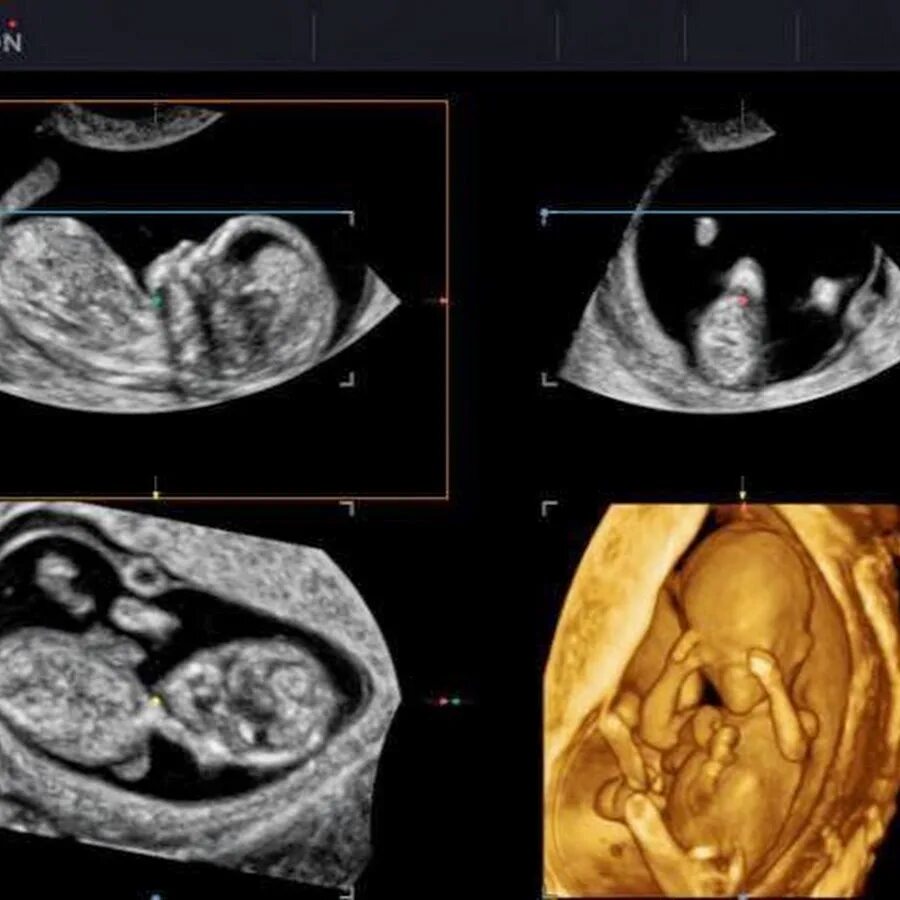 13 недель триместр. УЗИ на 13 неделе беременности 3d. 4 Д УЗИ на 13 неделе беременности.
