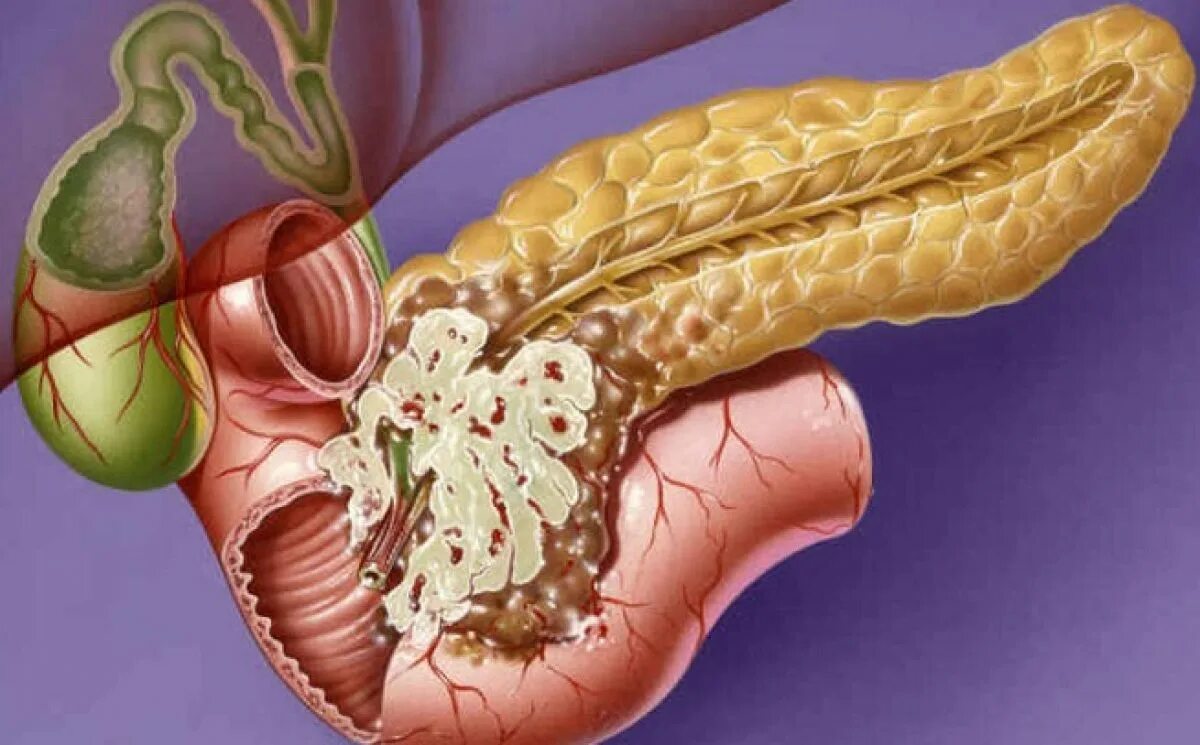 4 стадия поджелудочной железы сколько живут. Tumor головки поджелудочной железы. Карцинома поджелудочной железы симптомы. Аденокарцинома поджелудочной железы.