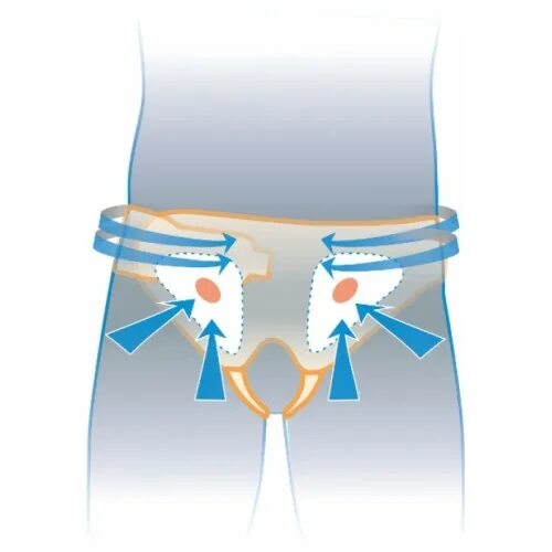 паховая грыжа поставили сетку. сетка для пупочной грыжи bard. грыжесечение паховой грыжи по лихтенштейну. бандаж грыжевой паховый бг-111. пластика паховой грыжи по лихтенштейну.