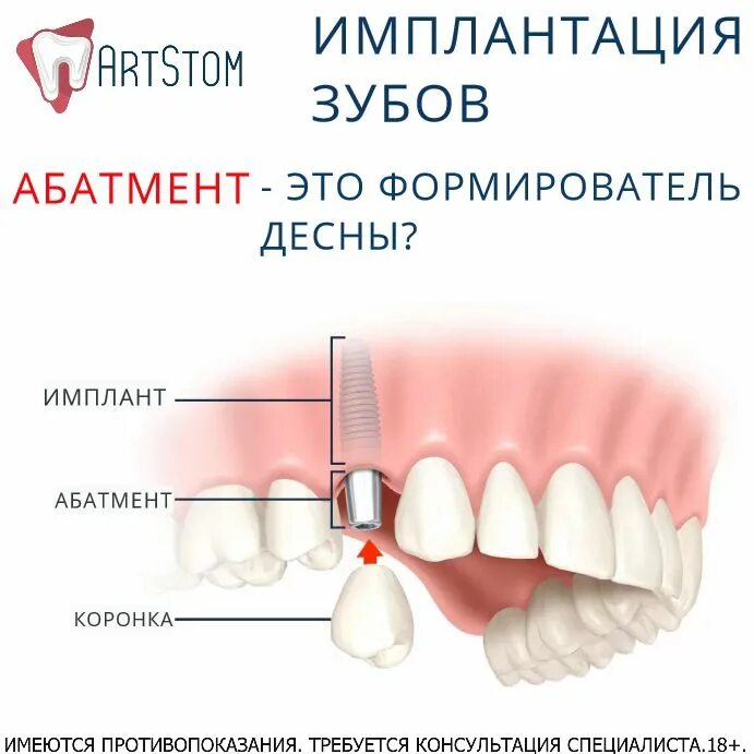 Зубы импланты поэтапно. Имплант формирователь абатмент. Что такое абатмент при имплантации зубов. Имплант зуба абатмент формирователь. Импланты формирователь десен.