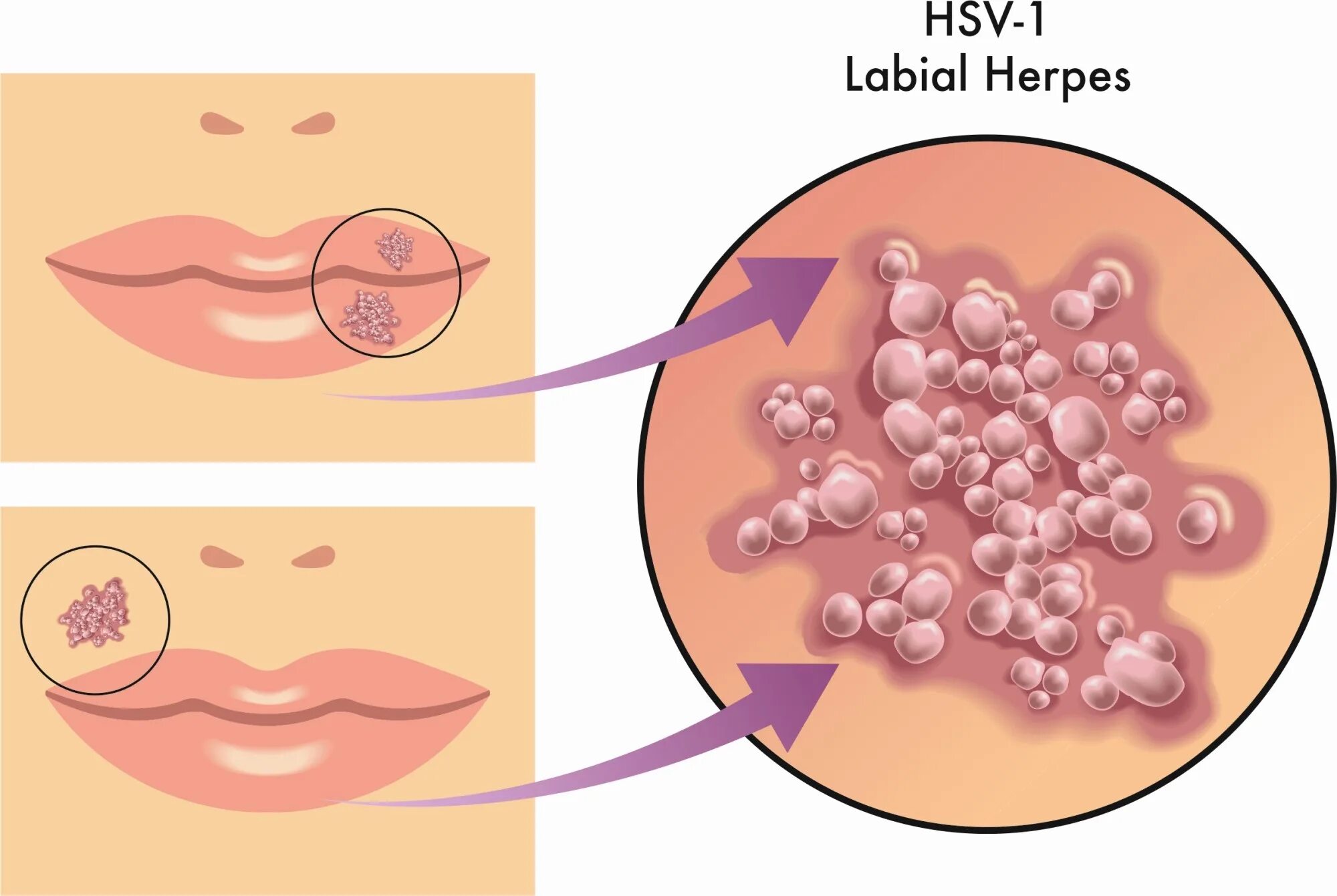 Герпетические высыпания на губах. Герпесвирусная инфекция на губах. Губы при орви