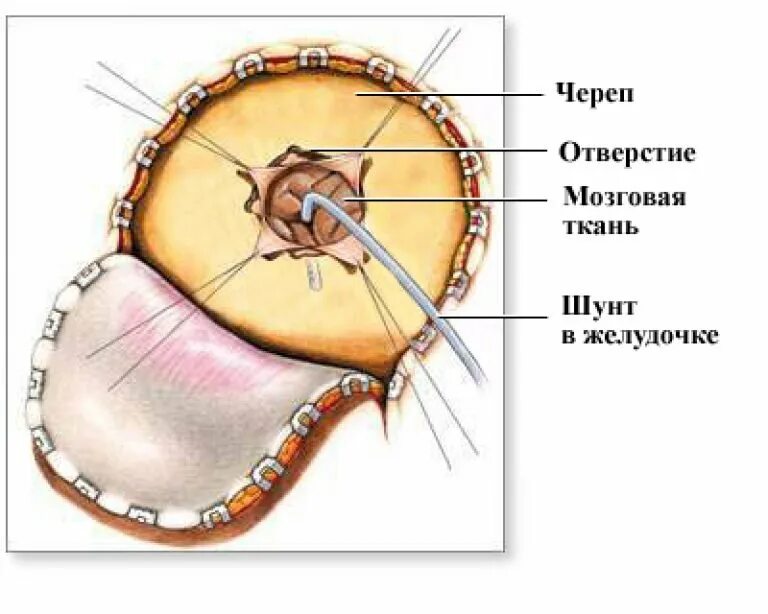 Шунт головного мозга. Шунтирование желудочков мозга. Шунтирование ликвора головного мозга. Шунтирование спинномозговой жидкости.