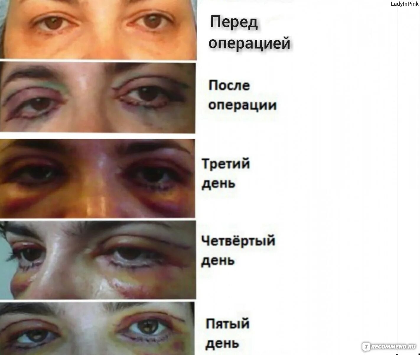 Лазерная блефаропластика. Отзывы прооперированных нижних, верхних век, фото до и