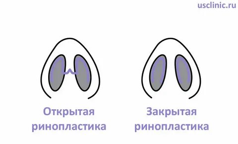 Выравнивание носовой