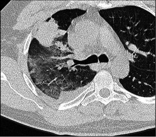 Ушиб легкого на кт. Внутрилегочная гематома кт. Ушиб легкого на кт. Гематома средостения кт. Внутрилегочные гематомы кт.