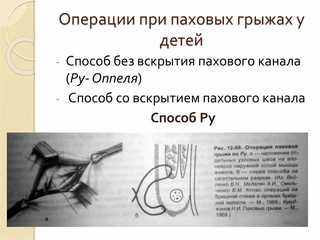 Паховая грыжа у ребенка симптомы. Операция при паховой грыже. операции при паховых грыжах. операция припахововй грыже. паховая грыжа операция.