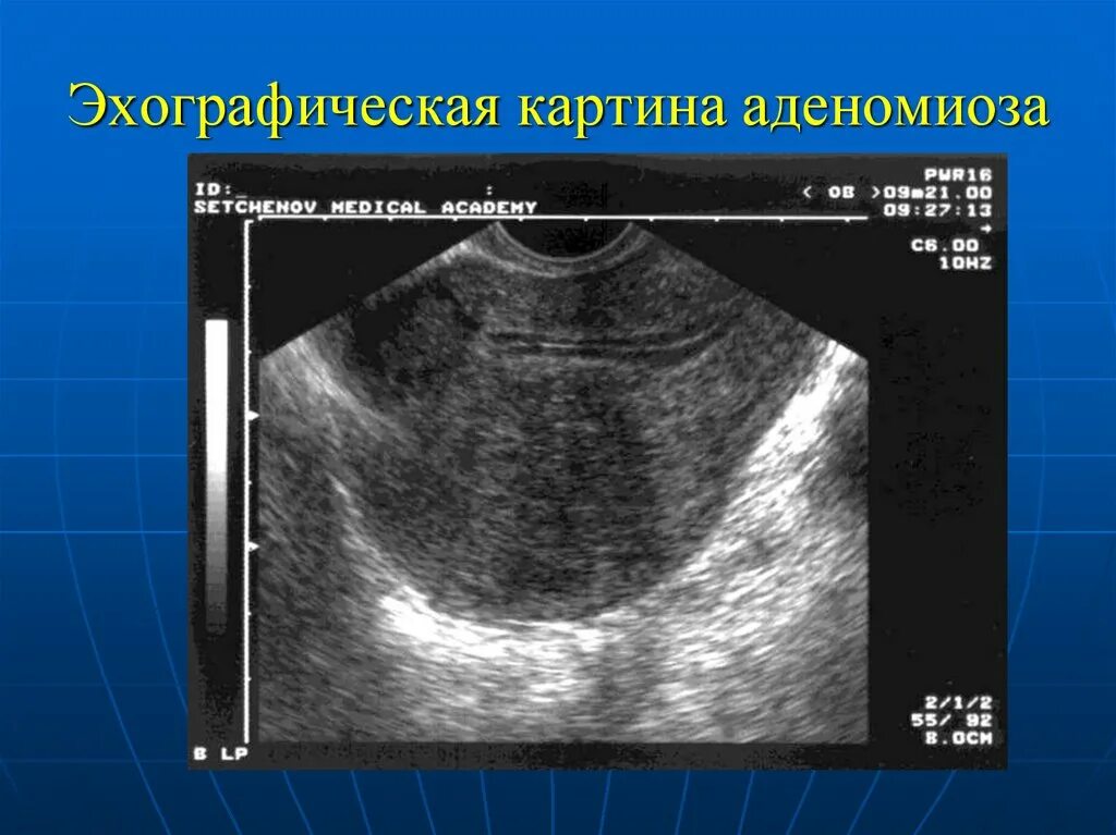 УЗИ картина аденомиоза эндометриоз. Диффузный эндометриоз матки УЗИ. Аденомиоз Узловая форма УЗИ. Эндометриоз Узловой формы на УЗИ.