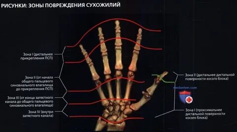 Мкб 10 сухожилия