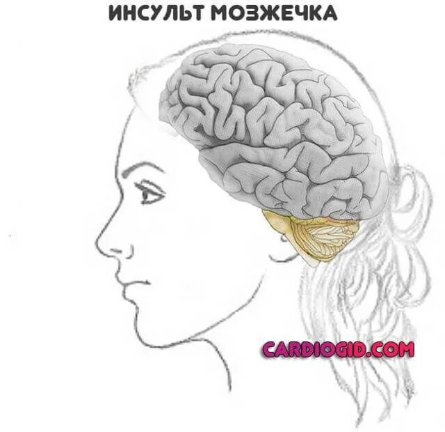 Предынсультное. Предынсультное состояние. Признаки предынсультного состояния у женщин. Ппедэнсультное состояние у женщины.