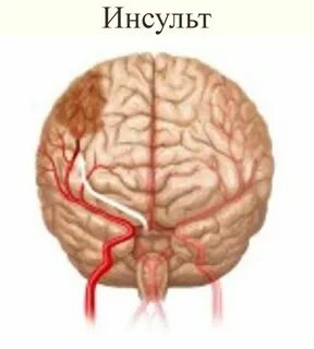 Что такое инсульт головного мозга