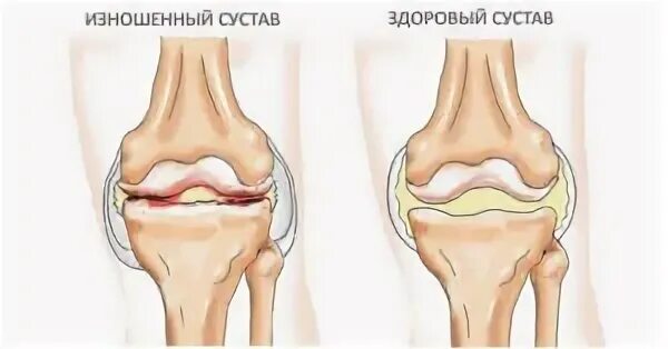 3 признака сустава