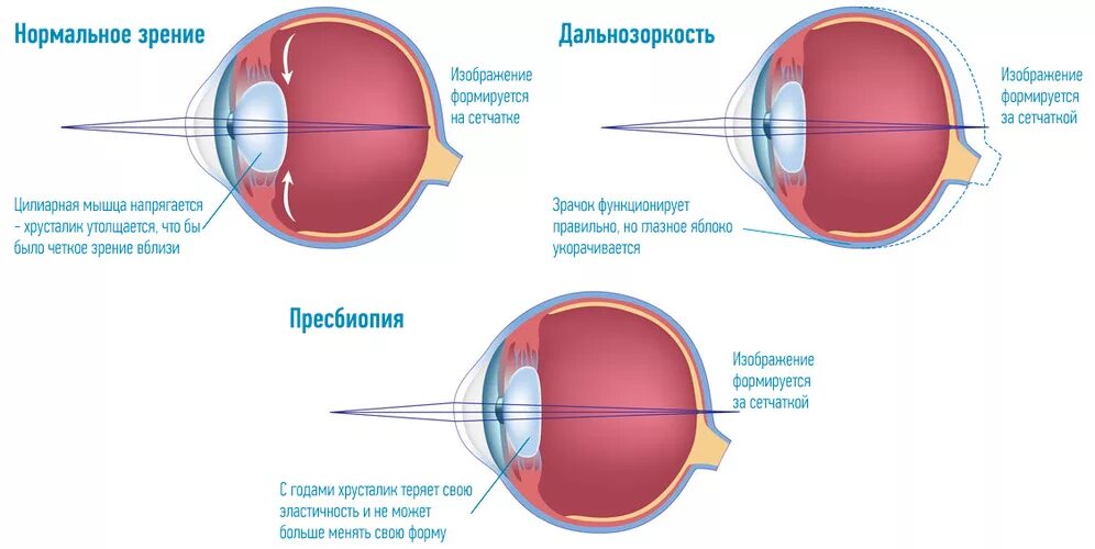 Зрения и дать решение. Таблица заболевания глаз близорукость и дальнозоркость. Старческая дальнозоркость (что это такое? Методы коррекции). Возрастные изменения сетчатки. Заболевание 1)  близорукость 2)  дальнозоркость.