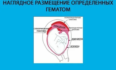 Отторжение беременности