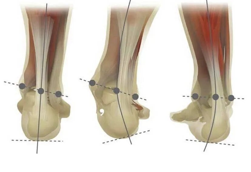 Угол голеностопного сустава. Вальгусная деформация косточки. Вальгусная деформация костей голеней. Плоско варусная деформация стопы. Варусная деформация стопы рентген.