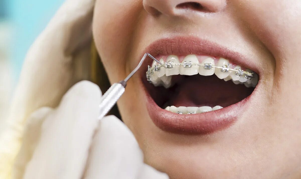 Врач ортодонт что это. Брекеты. Стоматология брекеты. Ортодонтия в стоматологии.