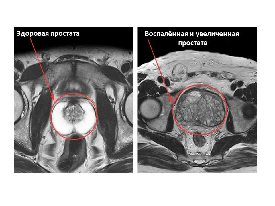 Кт малого таза с контрастом у мужчин. Аденома предстательной железы мрт. Гиперплазия предстательной железы мрт. Мультипараметрическое мрт предстательной железы. Мрт малого таза простата.