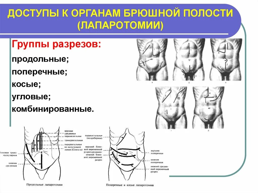 Брюшная стенка после операции. Линии разрезов для оперативного доступа к органам брюшной полости. Анатомия передней брюшной стенки Оперативная хирургия. Оперативные доступы к органам брюшной полости. Срединная лапаротомия схема.