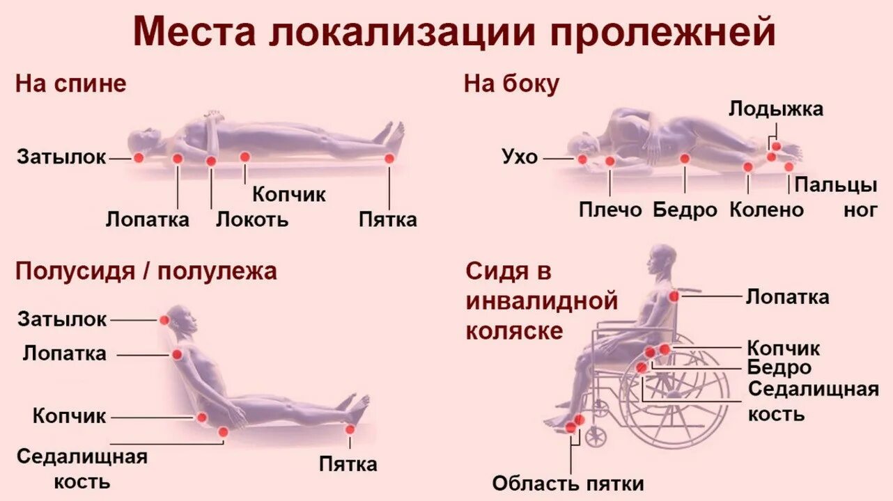 Пролежни клинические рекомендации 2020. Внешние факторы образования пролежней. Места локализации пролежней. Места возникновения пролежней таблица.