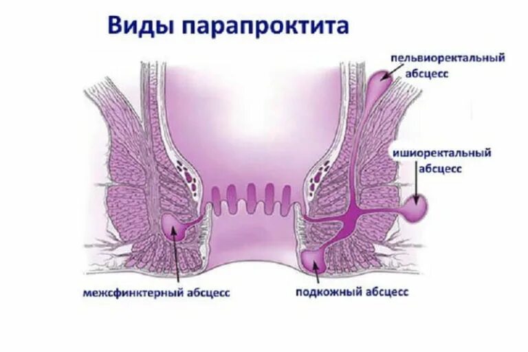 Сфинктерит прямой кишки симптомы. Хронический парапроктит ишиоректальный. межсфинктерный парапроктит. пельвиоректальный парапроктит симптомы.