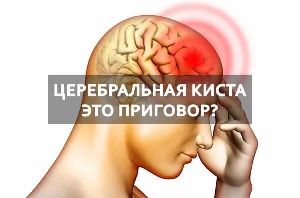 Чем опасна киста в мозгу. Лекарство от кисты головного мозга. Церебральная киста головном мозге. Таблетки от кисты в голове.