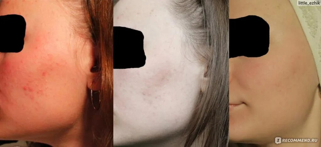 Клензит до и после отзывы Маска для лица Neutrogena ® Rapid Clear Stubborn Acne "Великий и ужасный бензо