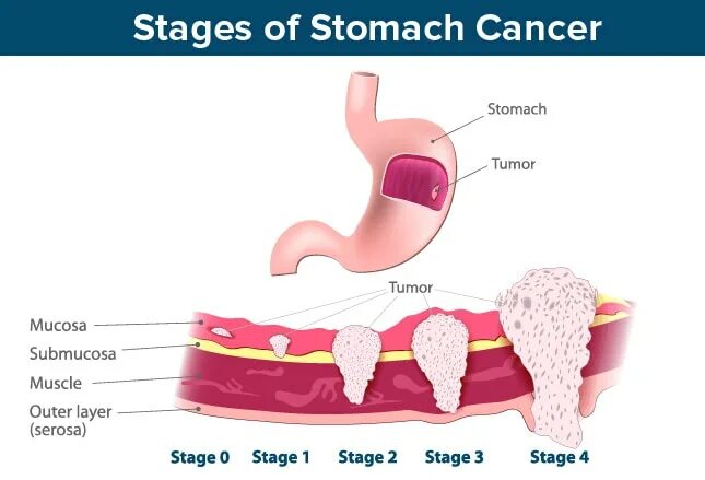 Stages of cancer